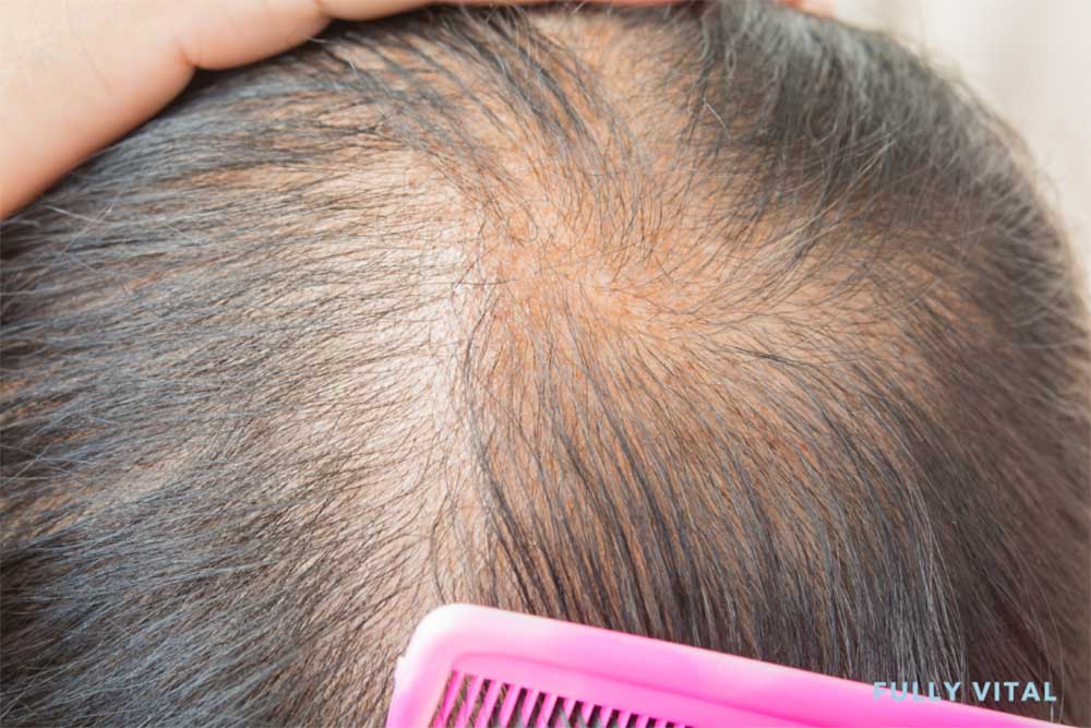 Diffuse alopecia