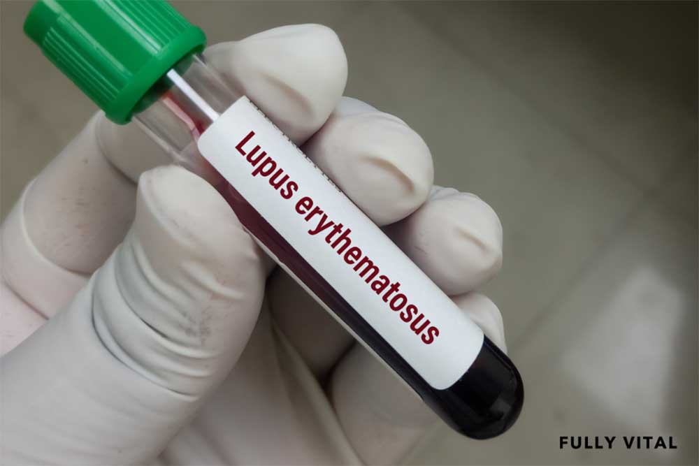 Patient blood with systemic lupus erythematosus