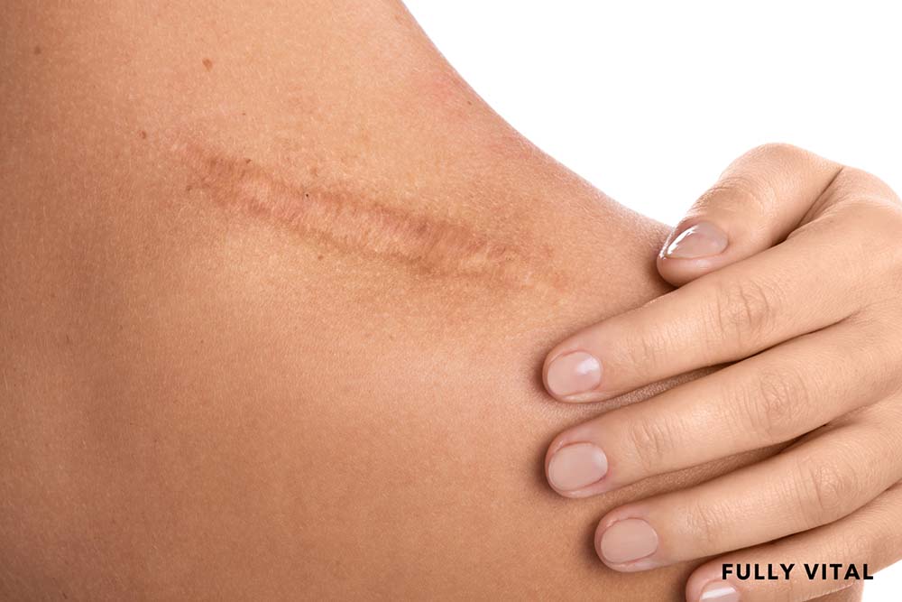 Derma roller for scars