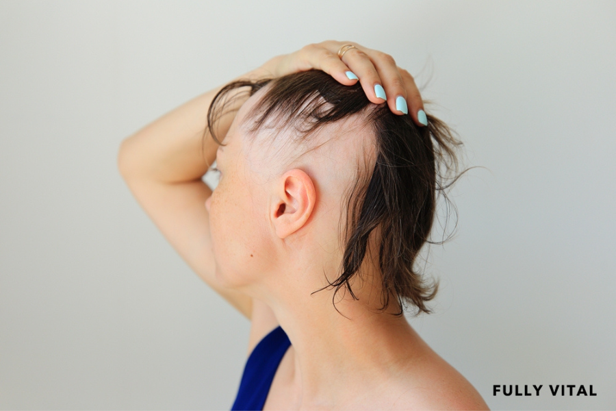 Folliculitis decalvans