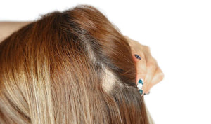 Alopecia Areata: Causes, Symptoms, Diagnosis and Treatment