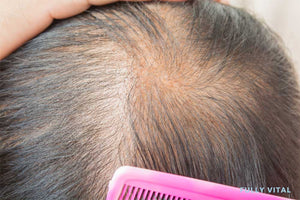 Diffuse alopecia