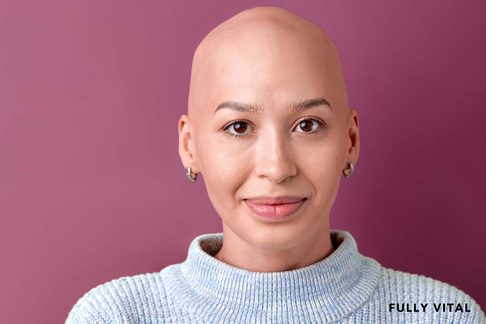 Bald woman with alopecia totalis