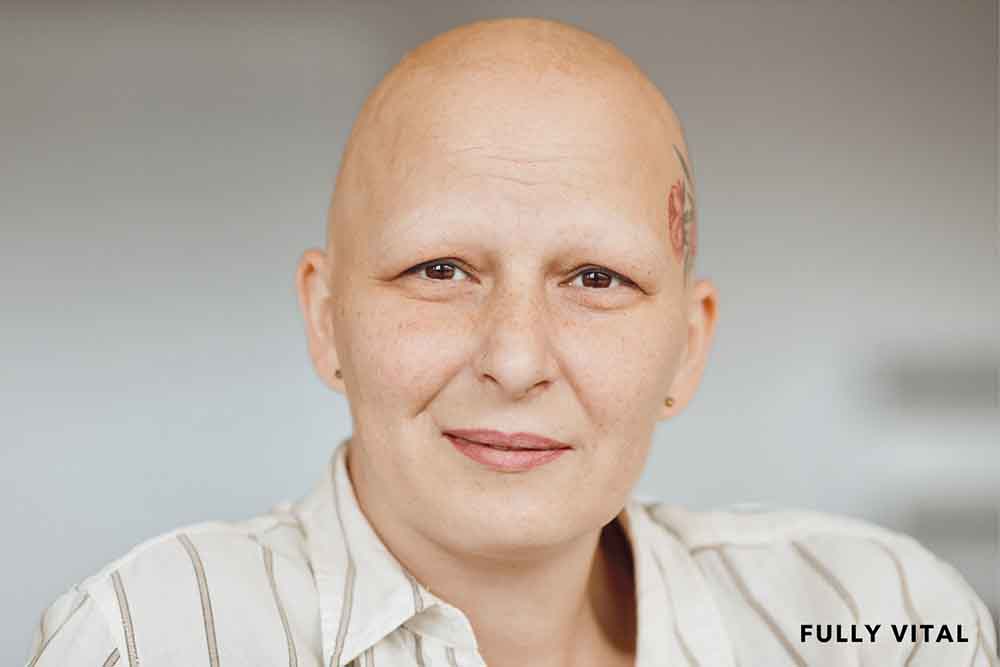 Woman with alopecia universalis