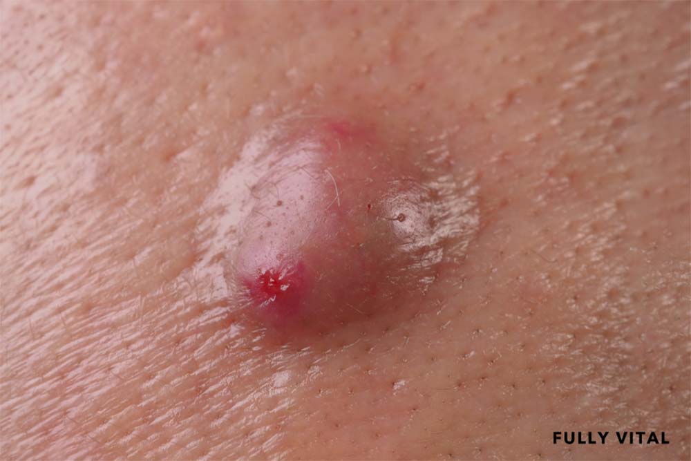 Hidradenitis Suppurativa
