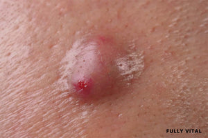 Hidradenitis Suppurativa