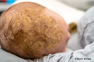 Child with cradle cap