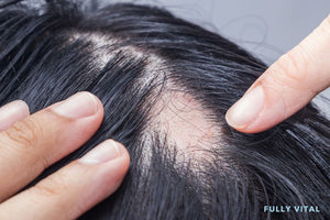 Cicatricial Alopecia