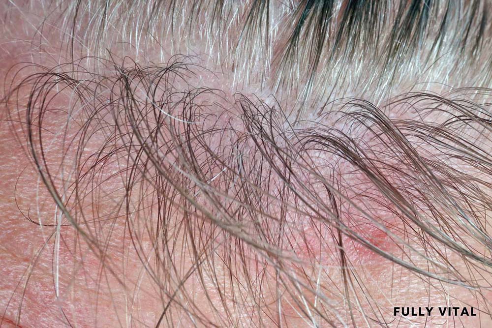 Clogged Hair Follicles A Comprehensive Guide to Promoting Healthy