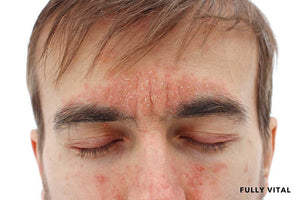 Man with discoid lupus erythematosus