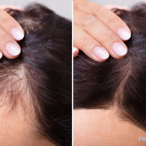 Transformative Finasteride Before And After: A Visual Journey Of Resul