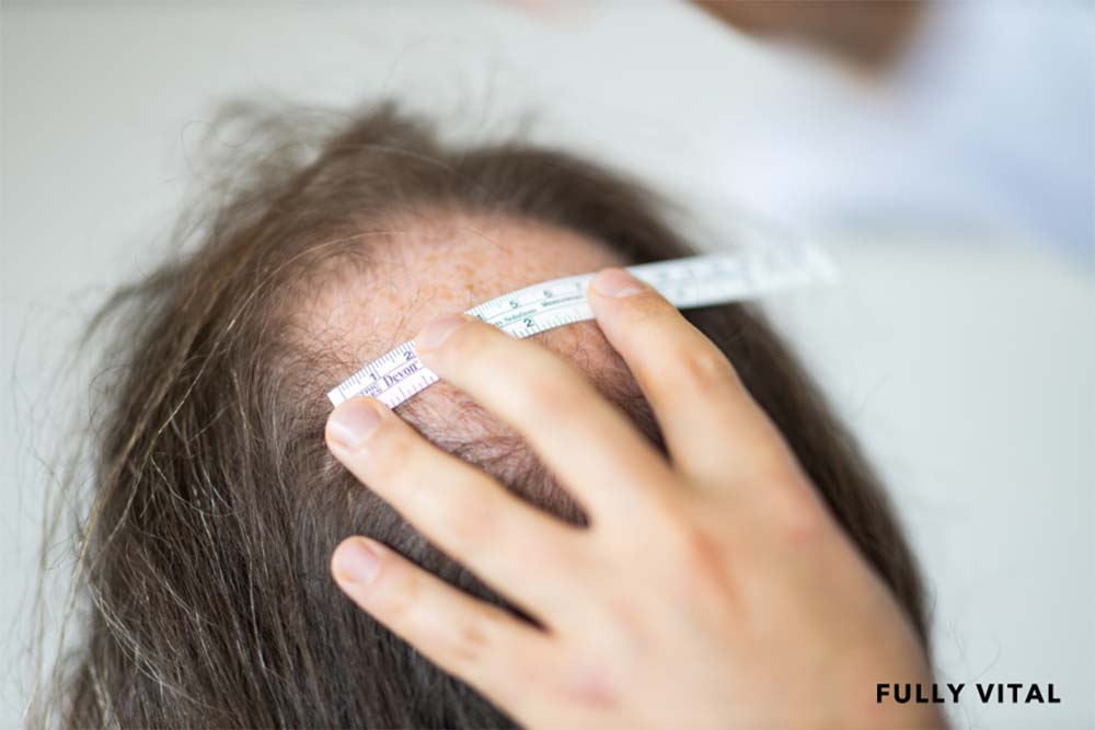 Measuring hair loss due to androgenetic alopecia