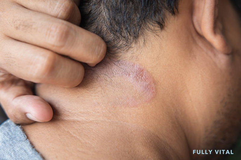 Tinea Capitis: Understanding This Hair Health Concern
