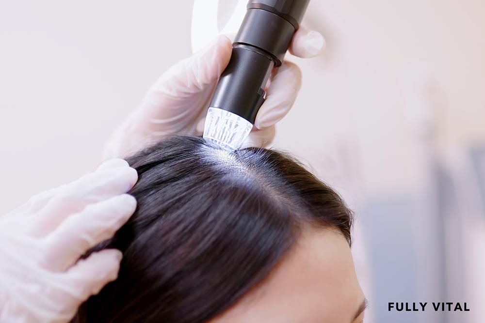 Micro needling: stimulate hair growth naturally