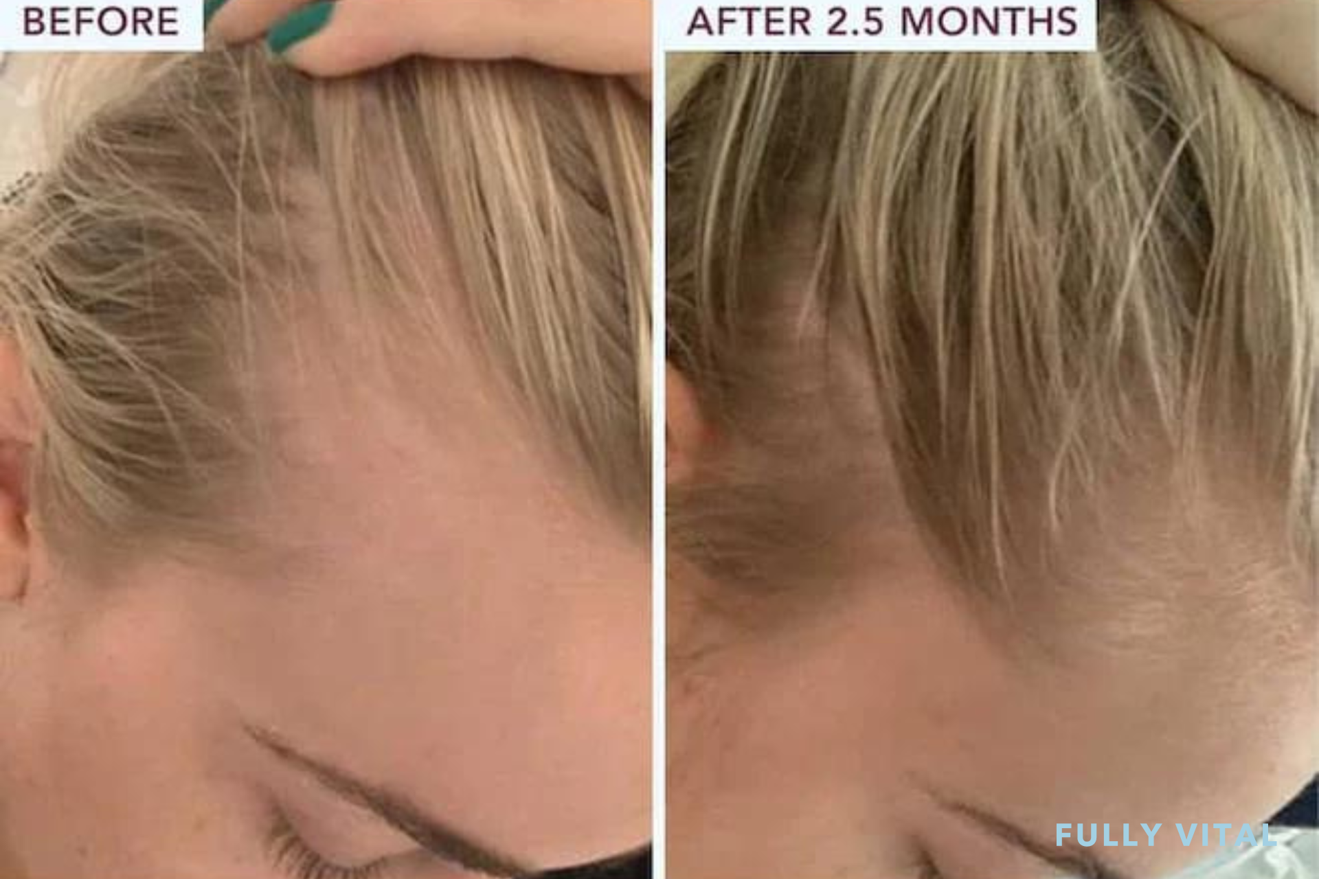 Microneedling before and after