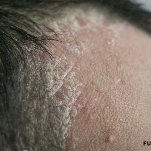 Understanding Pityriasis Amiantacea: A Comprehensive Guide For Hair ...