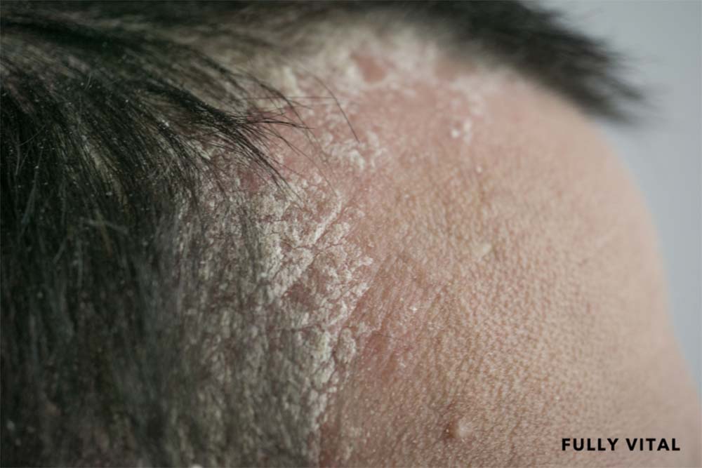 Pityriasis Amiantacea