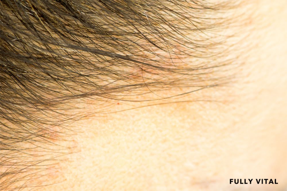 The Root Cause Of Scalp Inflammation: Understanding The Triggers And Treatment Options