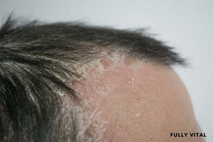 Scalp psoriasis