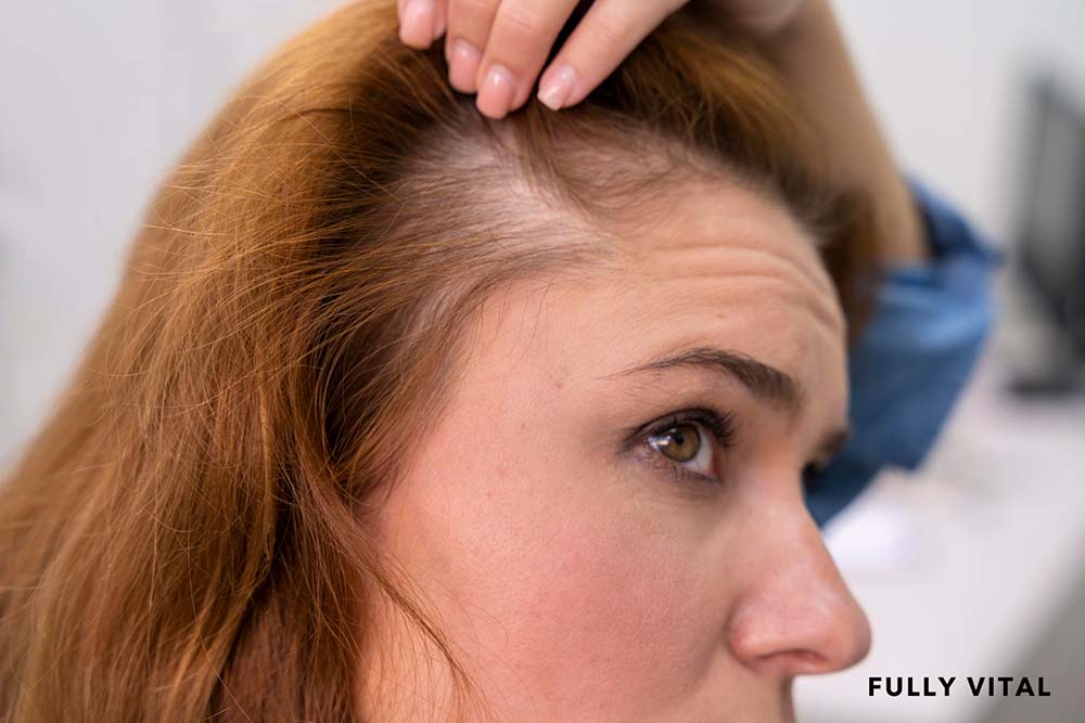  Derma roller for hair loss