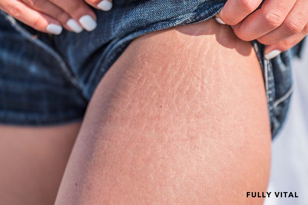 Microneedle stretch marks