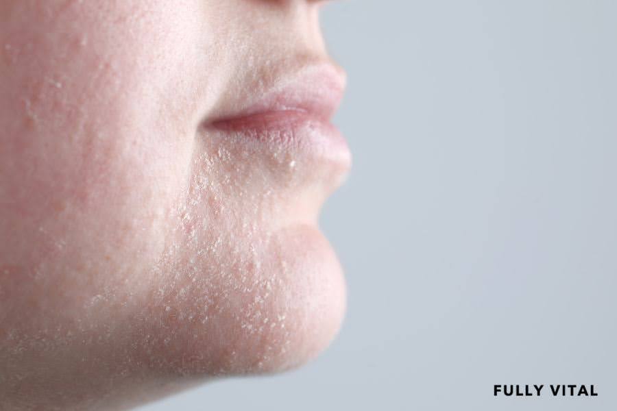 Tretinoin Purge Explained: Steps To Minimize Discomfort