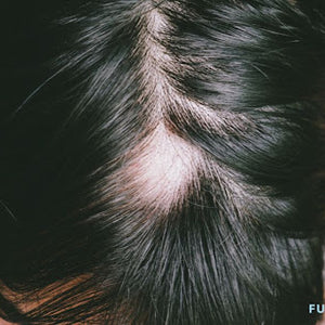 Triangular Alopecia: Understanding The Patchy Hair Loss Condition ...