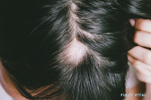 Triangular Alopecia: Understanding The Patchy Hair Loss Condition