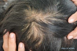 Trichorhinophalangeal Syndrome: Understanding And Preventing Hair Growth Issues