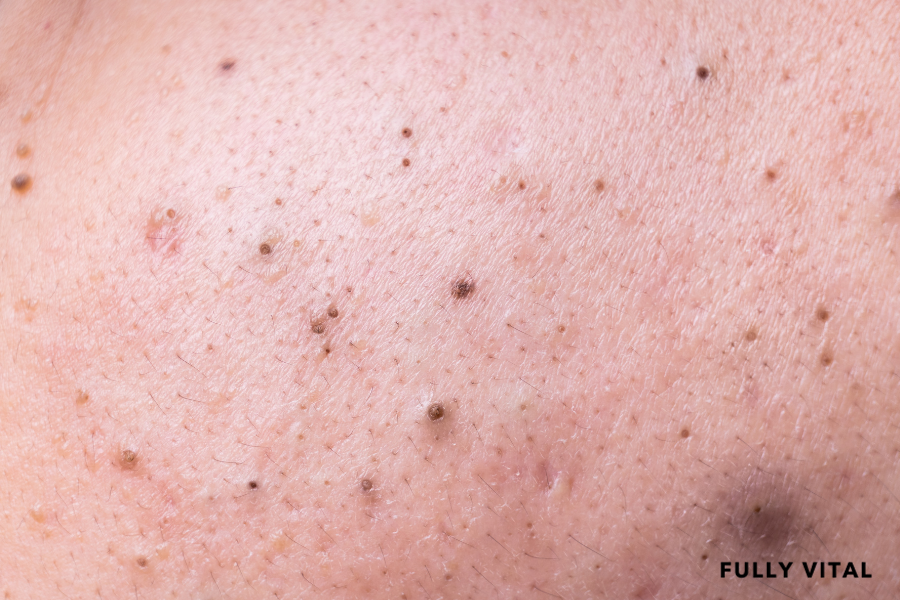 Dealing With Trichostasis Spinulosa: Tips For Relief And Recovery