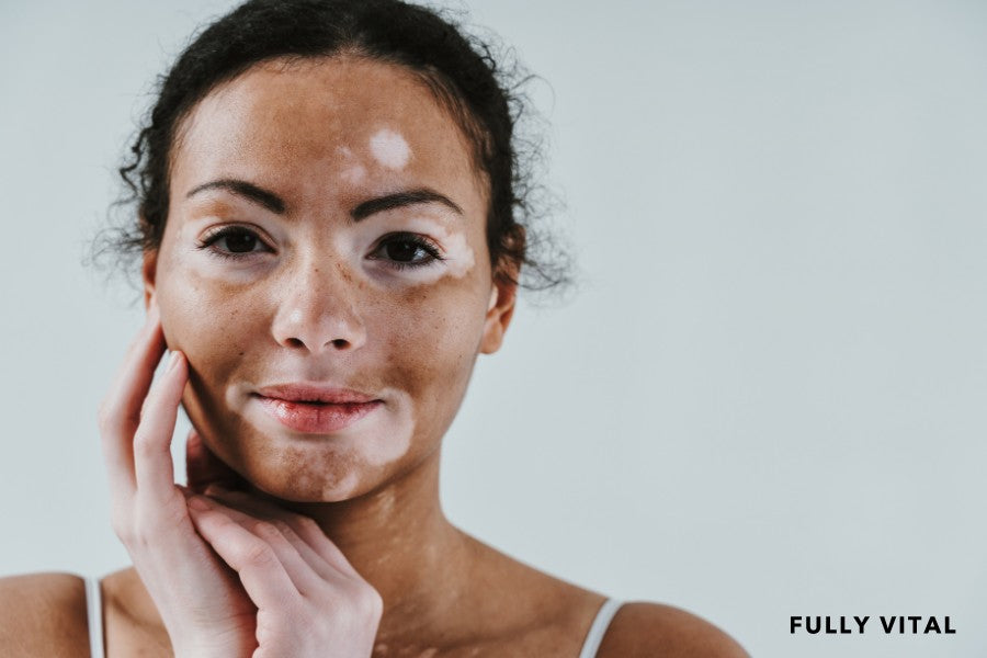 Understanding Vitiligo
