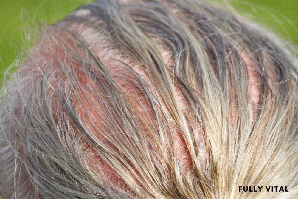 Woman with alopecia mucinosa