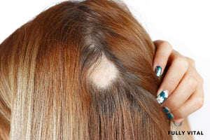 Alopecia Areata