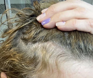 How To Regrow Baby Hairs After Hair Thinning?