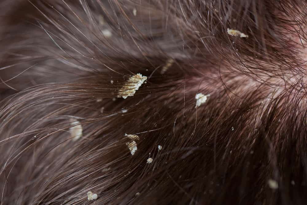 Is Dandruff Causing Your Hair Thinning?