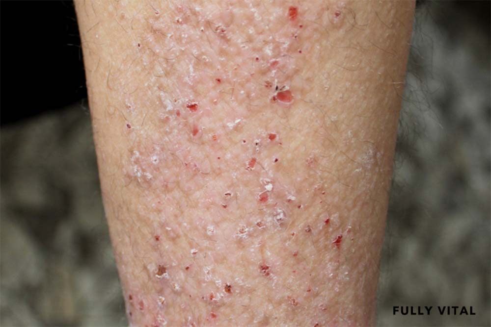 Lichen simplex chronicus on leg