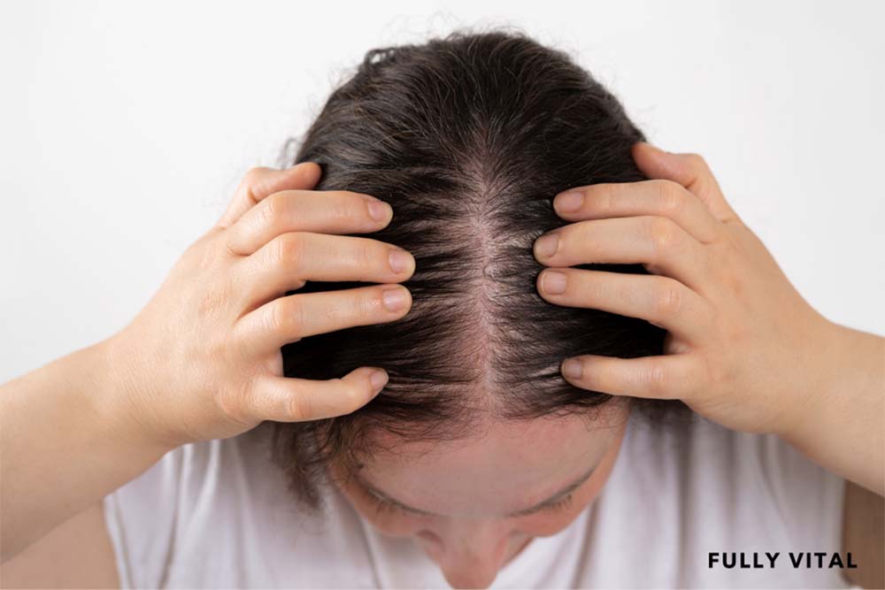 Female Receding Hairline Everything You Need To Know FullyVital
