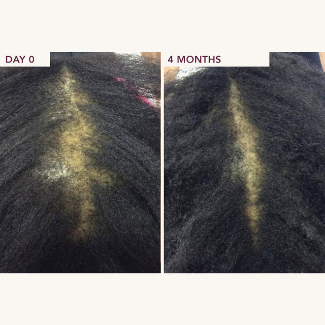6-Month Hair Wellness Bundle